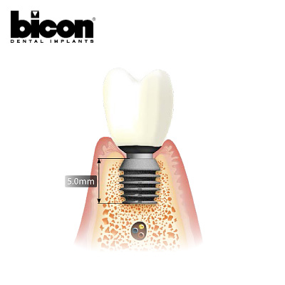 Bicon - implanty stomatologiczne Kraków