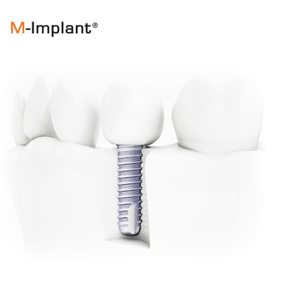 M-implant - implanty dentystyczne Kraków