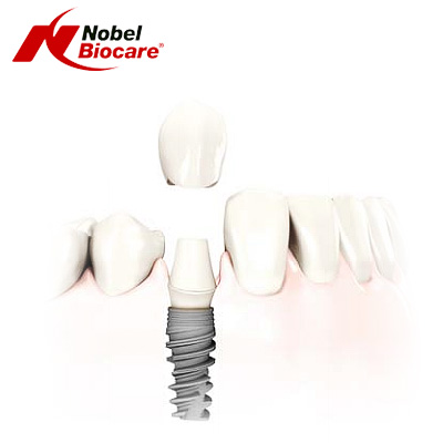 Nobel Active - rodzaje implantów stomatologicznych Kraków